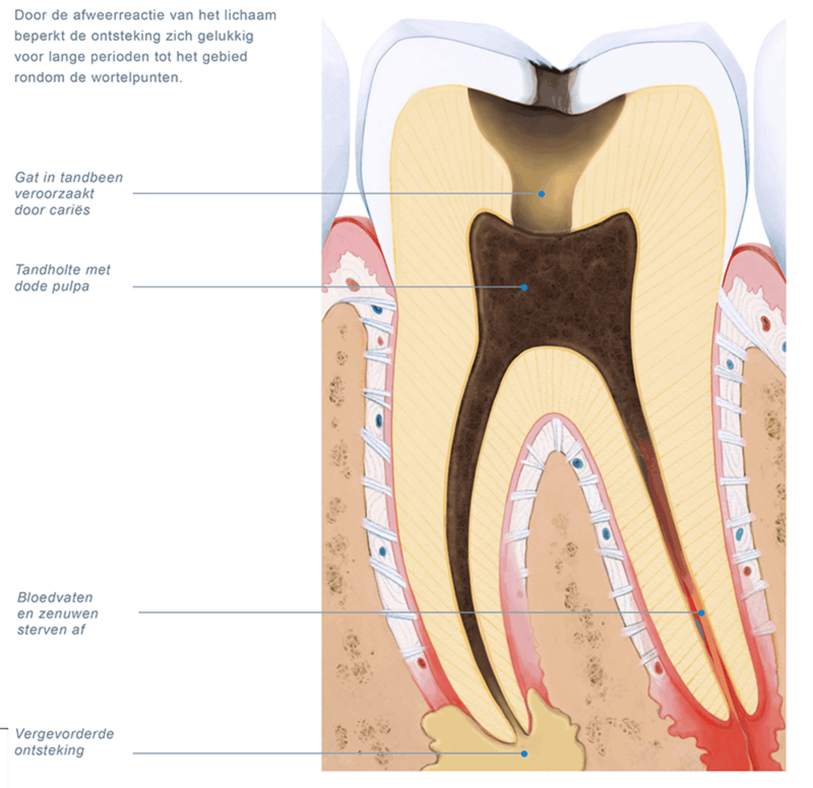 heden Ciro Herrie Dode pulpa | De Kliniek voor Tandheelkunde