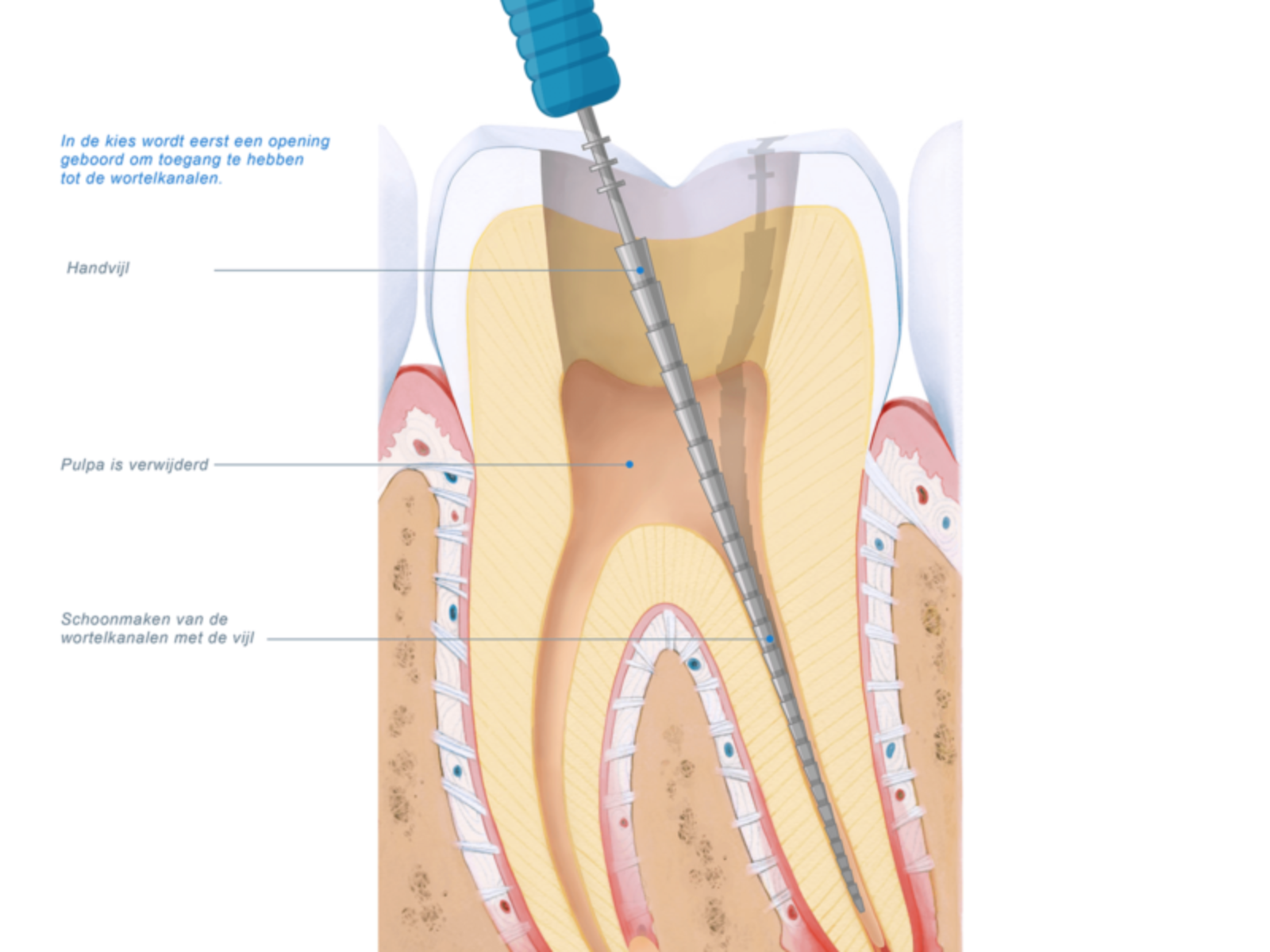 Wortelkanaalbehandeling | Kliniek voor Tandheelkunde