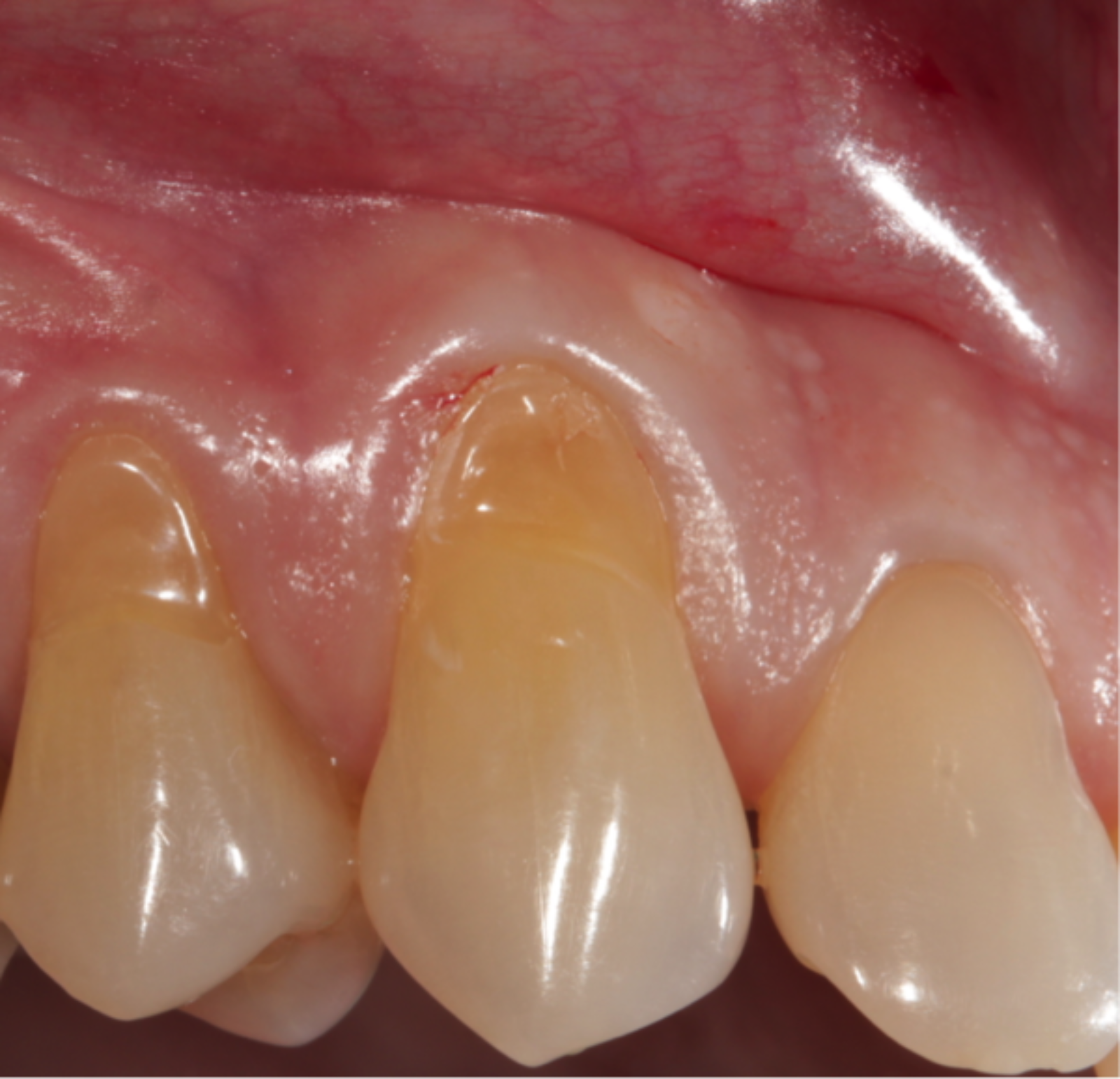 roem Voorspeller Rodeo Teruggetrokken tandvlees | De Kliniek voor Tandheelkunde